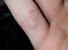 Wunde Wird Einfach Nicht Besser Schmerzen Finger