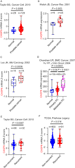 Prostate cancer cells may be referred to as adenocarcinoma. Discovery Of Casp8 As A Potential Biomarker For High Risk Prostate Cancer Through A High Multiplex Immunoassay Scientific Reports