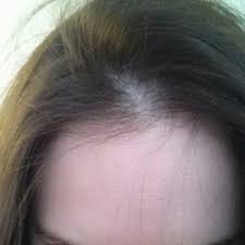 Lichenoid drug eruption caused by clonazepam. Does Overall Health And Medications Affect Prp Or Other Hair Loss Treatment Results Photo