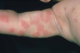 Nettle Rash Rash A Red Rash On The Arm Of A Four Food Allergies Food Allergy Rash Allergies