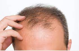 Are you often revved up, sweaty, or anxious? Hair Restoration For Thinning From Thyroid Disorders