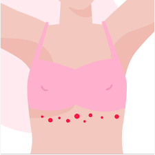 Image result for heat rash under breasts