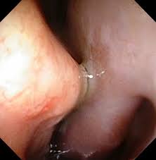 Blocked Nose I Don T Have Coronavirus But I Can T Breathe Ent Specialist Singapore