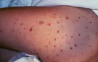 Typically, it affects the fronts of the legs and the buttocks. A Boy With A Purpuric Rash Of Sudden Onset Medicine Today