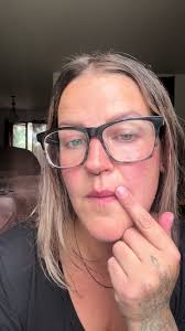 Dr Marc Mani Scar Revision