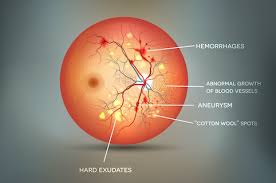 Learn more about the healthy people 2020 vision topic area. Diabetic Eye Conditions Muskegon Diabetes Fremont Shoreline