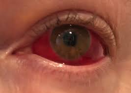 On today's health minute, emergency room physician dr. I Popped A Blood Vessel In My Eye Mildlyinteresting