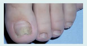 Image result for Onycholysis feet