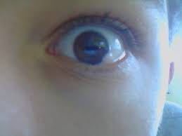 Wann sollte ich mich eincremen oder schminken? Darf Man Mit Einer Zyste Auf Dem Auge Eine Kontaktlinse Tragen Medizin Arzt Krankheit