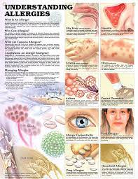 Understanding Allergies Chart 20x26 Allergies Most Common Allergies Managing Allergies