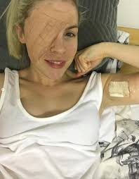 This Skin Cancer Awareness Month, we're proud to share the inspiring story  of Jessica Zbinden-Webster, a skin cancer survivor and the powerful voice  behind the Axe the SPF Tax campaign in the