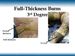 Figure 3 from burn wound care semantic scholar / an eschar (/ ˈɛskɑːr /;. Chapter 21 Burns Topics Introduction To Burn Injuries