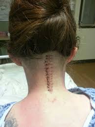 Pin On Arnold Chiari Malformation