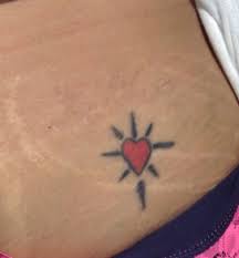 Come in today for a free consultation and test spot, or click for an online price. Tattoo Removal Long Island Manhattan Ny
