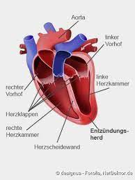 Eine herzmuskelentzündung ist oft die folge eines harmlosen grippalen infekts. Herzmuskelentzundung Symptome Ausloser Risiken Netdoktor