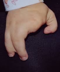 Ectrodactyly Wikipedia
