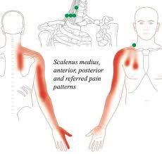 Trigger Point Therapy Treating The Scalenes Release Techniques Trigger Point Therapy Trigger Points Cupping Therapy