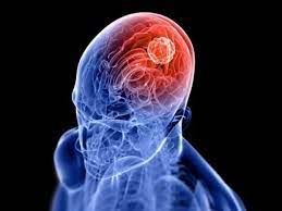 Vari fattori di rischio sono associati a ictus emorragico; Emorragia Cerebrale Cause Sintomi E Terapia Tanta Salute
