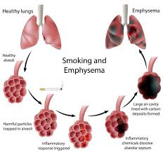 Pin On Copd