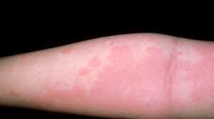 Noncontagious rashes include seborrheic dermatitis, atopic dermatitis, contact dermatitis, stasis dermatitis, psoriasis, nummular eczema, drug eruptions, hives, heat rash (miliaria), and diaper rash. Photos And Symptoms Of Common Food Allergy Symptoms