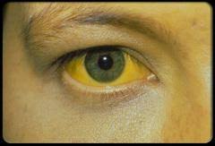 Maybe you would like to learn more about one of these? Mata Kuning Dan Nafsu Makan Berkurang Tanda Hepatitis Tribunnews Com Mobile