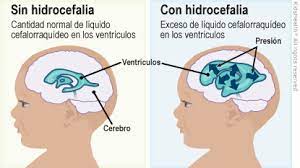 La hidrocefalia puede causar daños permanentes en el cerebro y provocar problemas con el desarrollo físico y mental. Hidrocefalia