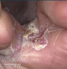 Image result for pompholyx soles of feet