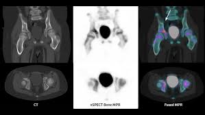 Image result for Osteomyelitis Bone Scan
