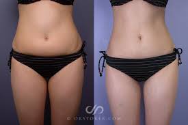 Image result for Liposuction