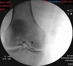 Image result for Knee Joint Injection