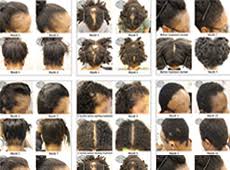 My hair loss began in 1999, and i didn't start wearing hair until 2012. Hair Loss Conditions Which Disproportionately Affect Black Women