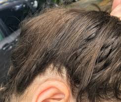 A protein present in egg white, avidin, tightly binds biotin, also. Dead Vs Live Nits Color Of Lice Eggs My Lice Advice