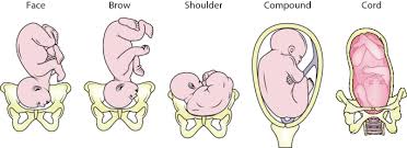 Image result for Compound Presentation