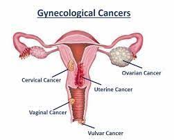 In some cases, women may be. Failure To Diagnose Ovarian Vaginal Cervical Cancer Gynecoligic Cancers Frith Ellerman Law Firm P C