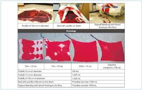 The presence of significant amount of blood in the chest will be identified during breathing in the primary. Scielo Brasil Postpartum Hemorrhage Prevention Diagnosis And Non Surgical Management Postpartum Hemorrhage Prevention Diagnosis And Non Surgical Management