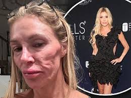 Brandi Glanville reveals doctor's shock theory about the REAL reason her  face is now unrecognizable