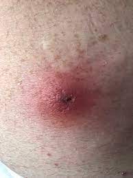 Check out the pronunciation, synonyms and grammar. Myiasis Wikipedia