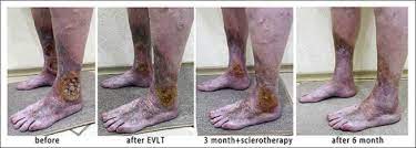 Evlt And Foam Form Sclerotherapy As A C6 Stage Varicose Treatment European Journal Of Vascular And Endovascular Surgery