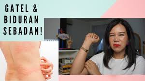 Aku mohon kepada allah yang maha agung, tuhan yang mempunyai arasy yang besar, semoga allah menyembuhkan engkau. 5. Cara Mengatasi Biduran Gatal Gatal Urticaria Giveaway Youtube
