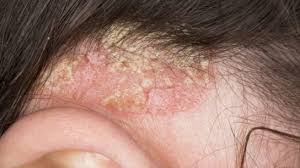 Some types of skin cancer are more dangerous than others, but if you have a spot. Skin Cancer Acne Skin Injury Dermatology News Treatment Studies