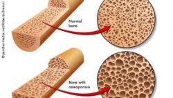 A cross section of a human long bone. Researchers Describe Mechanism That Underlies Age Associated Bone Loss Medica World Forum For Medicine