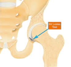 Image result for Hip Labral Tear