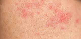 Image result for contact dermatitis