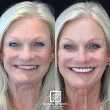 Meet Pam! We are thrilled to share her stunning full mouth veneer  transformation. Pam came to us looking to enhance her smile, and we are so  proud of the incredible results! Her