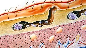 Scabies is not usually a serious condition, but it does need to be treated. What Is Scabies Symptoms Causes Diagnosis Treatment And Prevention Everyday Health