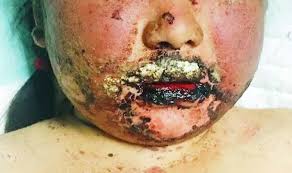 Stevens Johnson Syndrome In Systemic Lupus Erythematosus The Bmj