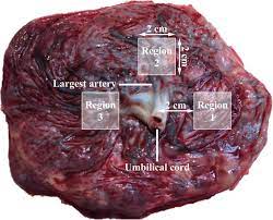 Placentas consisting of three or more lobes are extremely rare. Variability Of Iodine Concentrations In The Human Placenta Scientific Reports