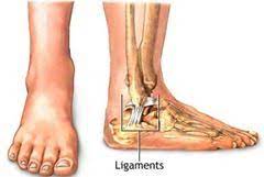 Torn Ligament In Foot Sprained Ankle Ligament Tear Twisted Ankle