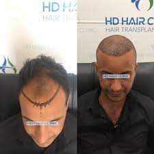 5450 Greft Ekimi Ile Max Sayi Natural On Cizgi Ve Profesyonel Ekibin Ellerinde Bizimle Guvendesiniz الان في مركز اسطنبو Hair Clinic Choker Necklace Necklace