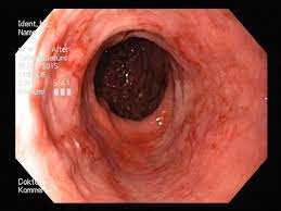 Mögliche symptome dafür sind das sogenannte „kaffeesatzerbrechen sowie blut im stuhl. Gastroenterologie Krankheitsbilder Praxis Fur Innere Medizin In Walldorf